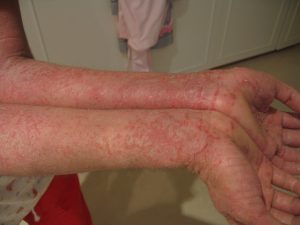 atopowe zapalenie skóry na rękach