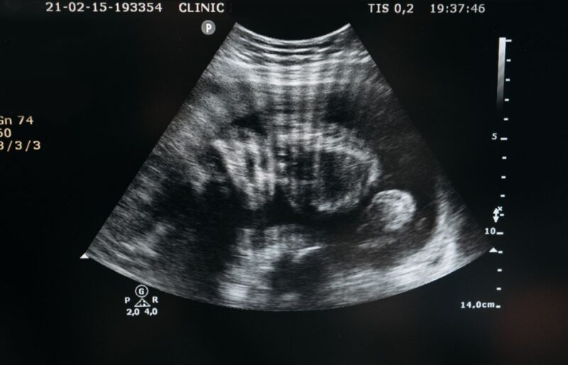 badania prenatalne Toruń